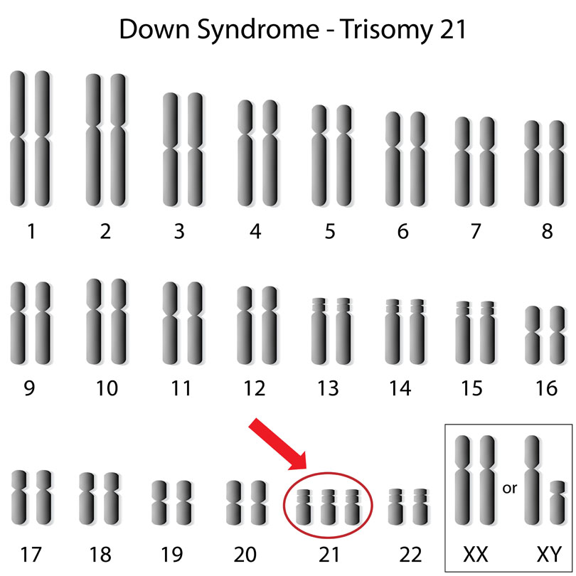 Down Syndrome - Introduction and an Overview
